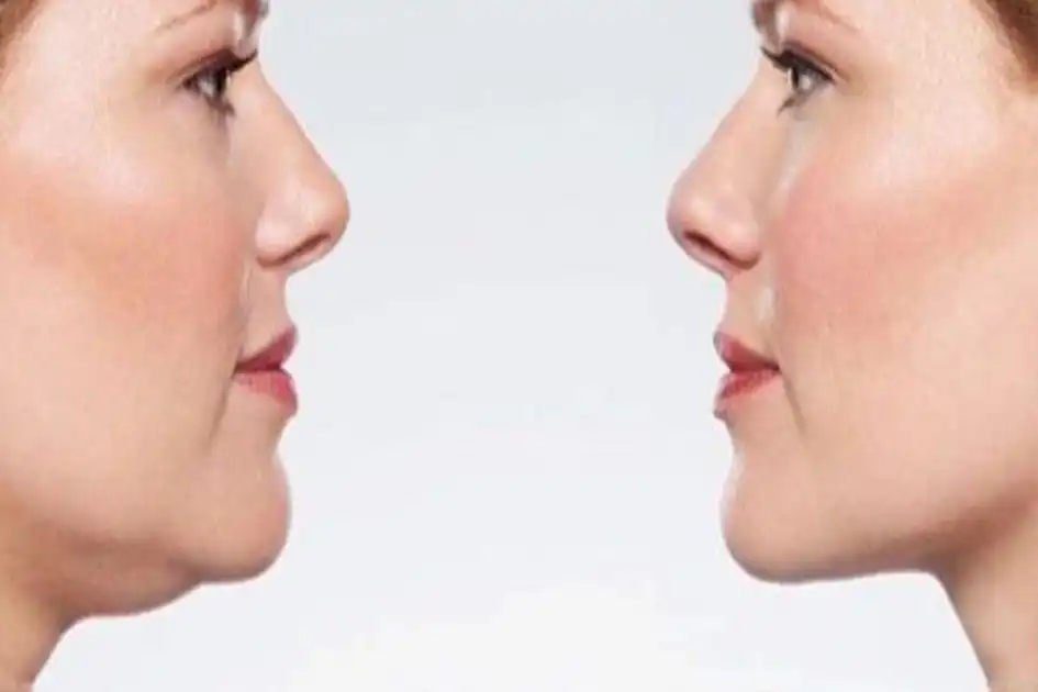 Tập gym có giảm mỡ mặt không? Cách giảm mỡ nọng cằm nhanh